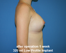 plastic-surgery-breast-augmentation